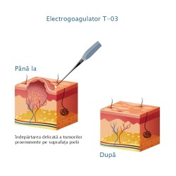 Aparat de electrocoagulare T-03 Professional