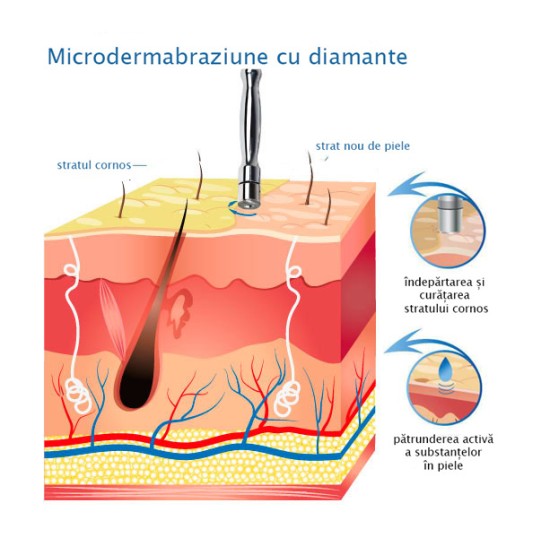 Aparat de microdermabraziune cu diamant T-06