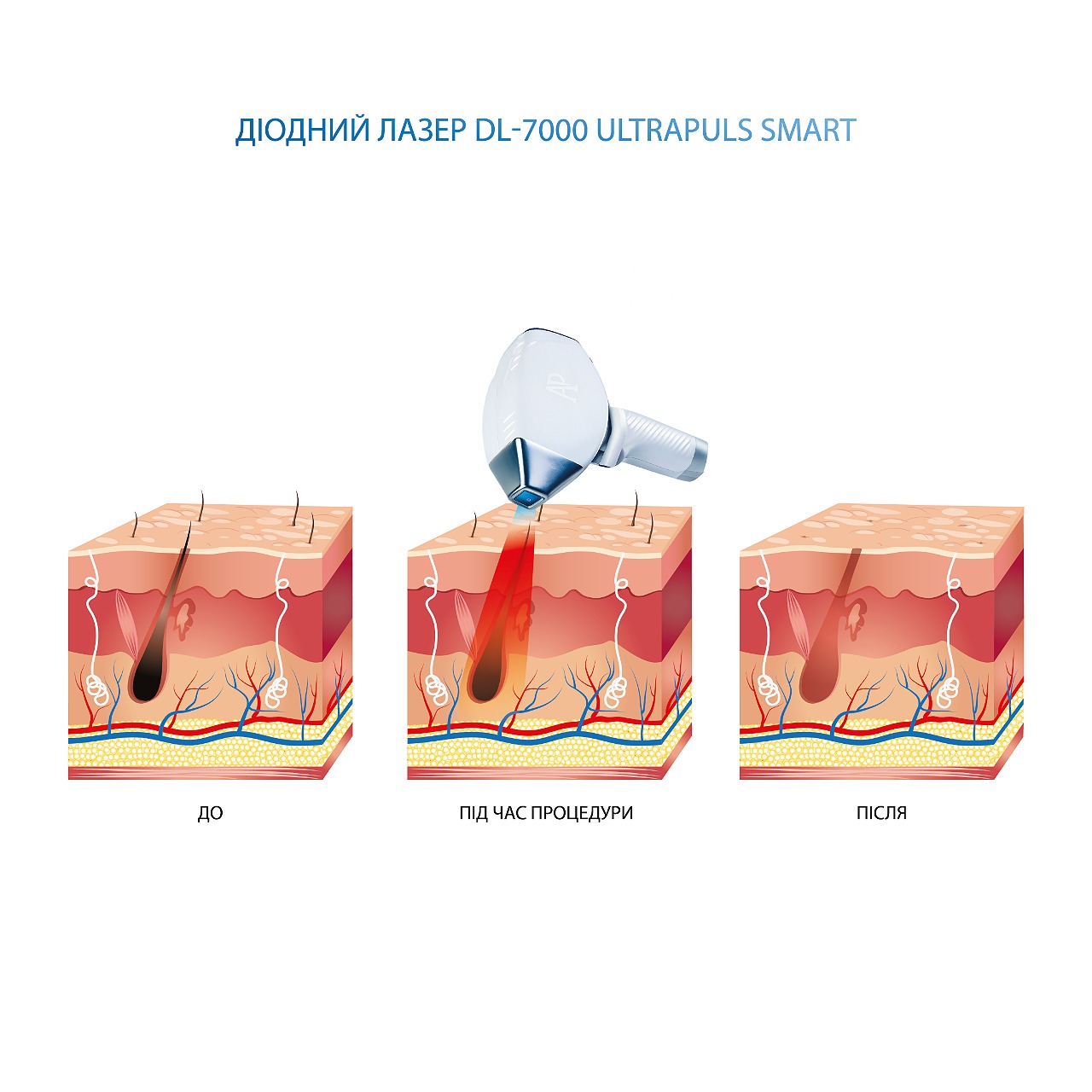 Laser cu diodă pentru epilare UltraPuls DL-7000 Smart