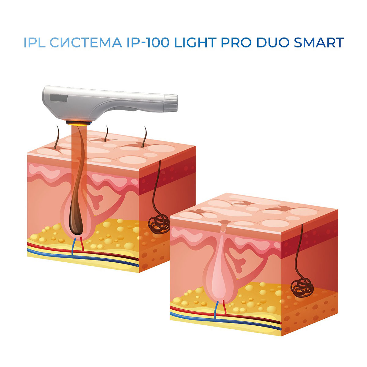 IP-100 LightPro фотоэпилятор AlviPrague